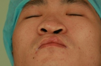 采用闭合切口的鼻中隔软骨移植在单侧唇裂术后鼻畸形矫正中的应用
